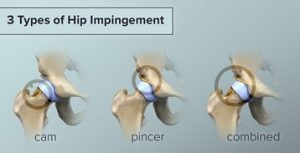 3 Types of Hip Impingement 